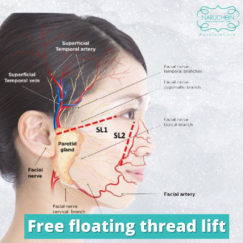 Free Floating Thread Lift