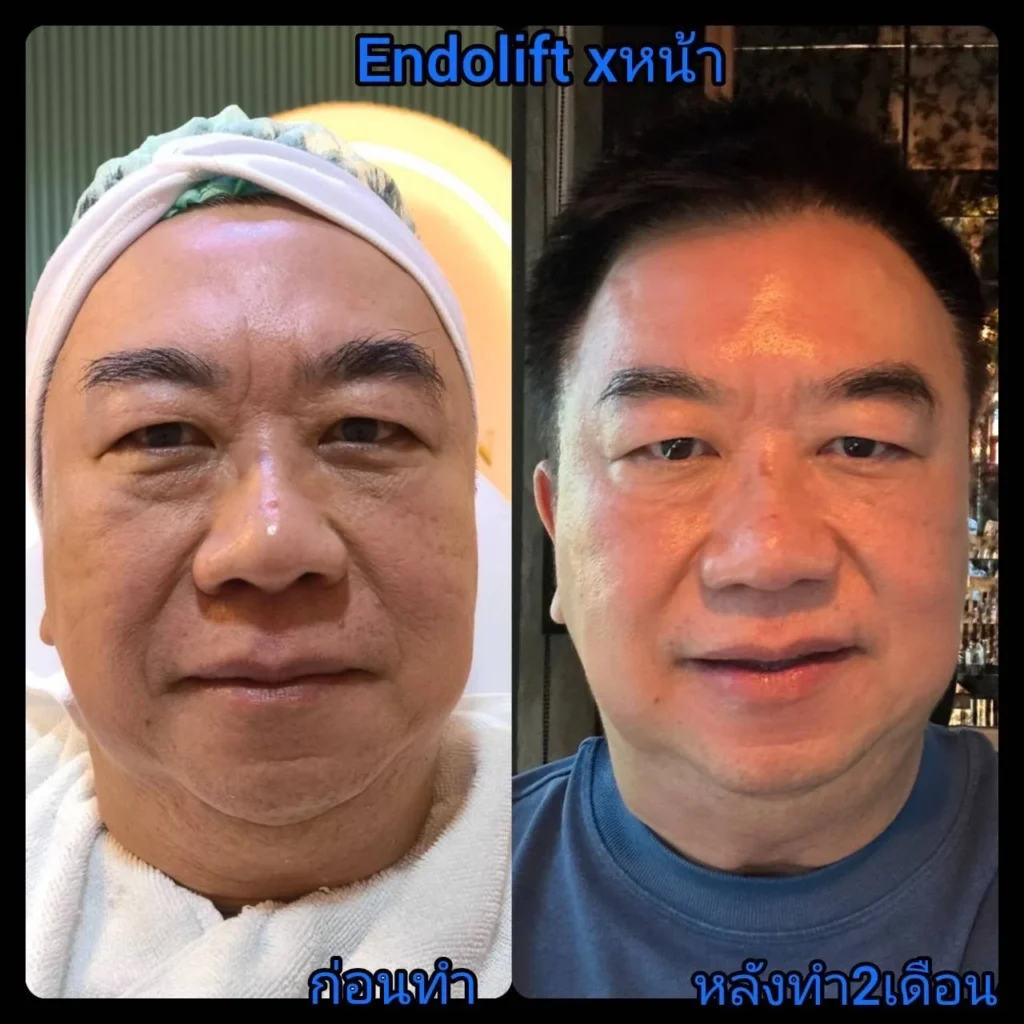 รีวิว EndoliftX 12