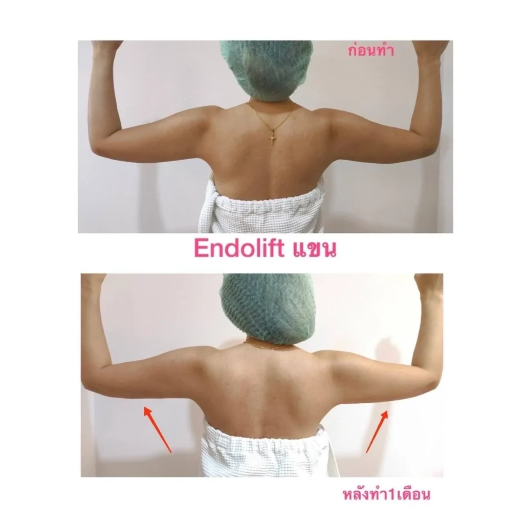 รีวิว EndoliftX 14