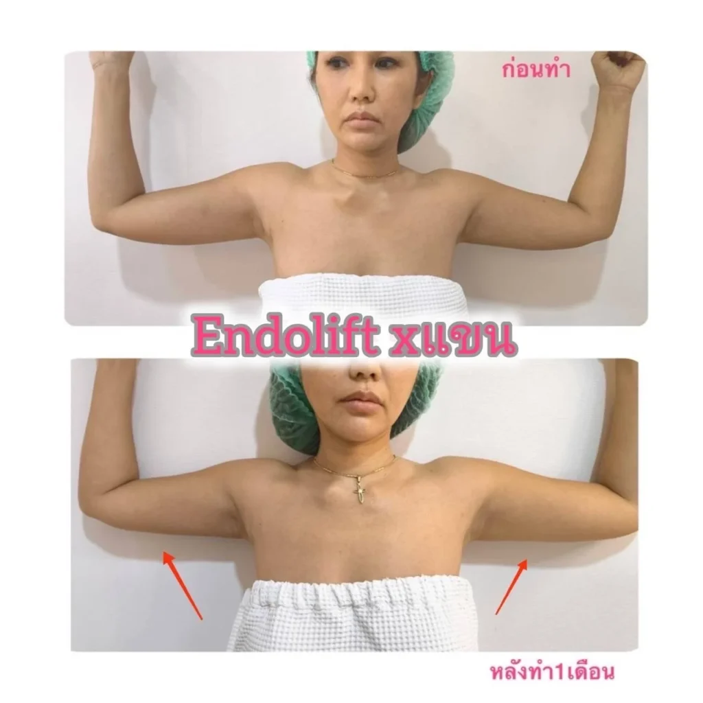 รีวิว EndoliftX 15