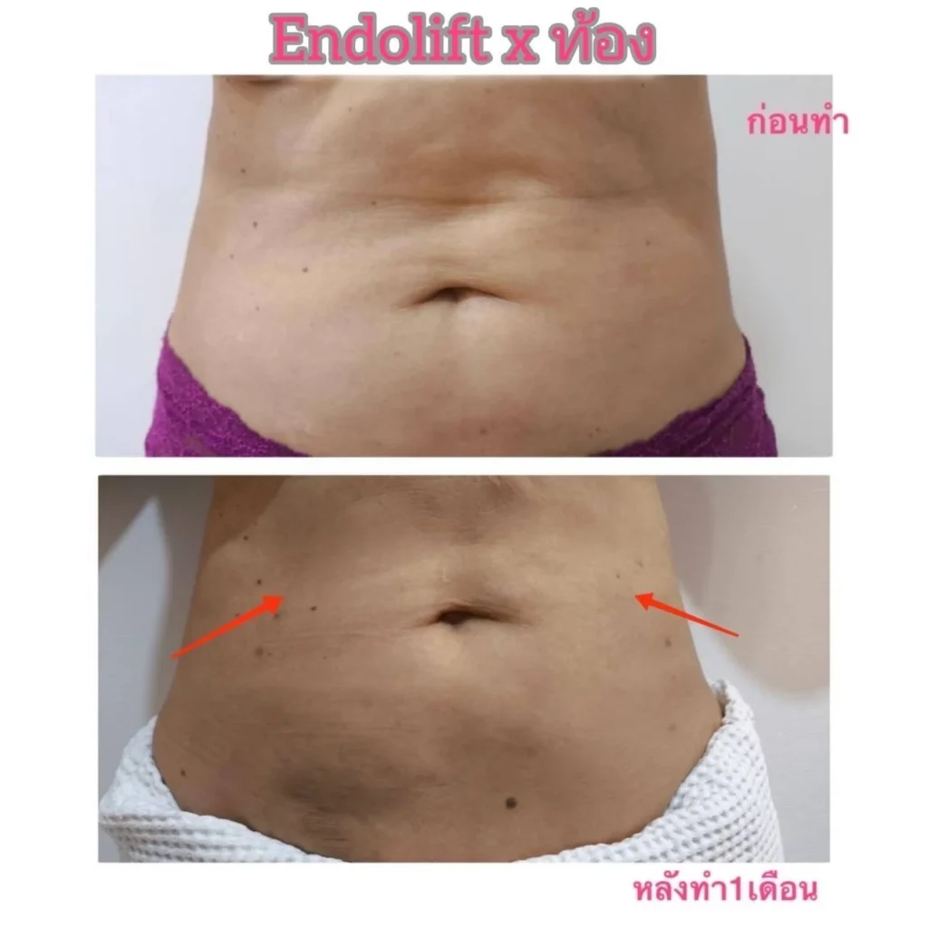 รีวิว EndoliftX 16