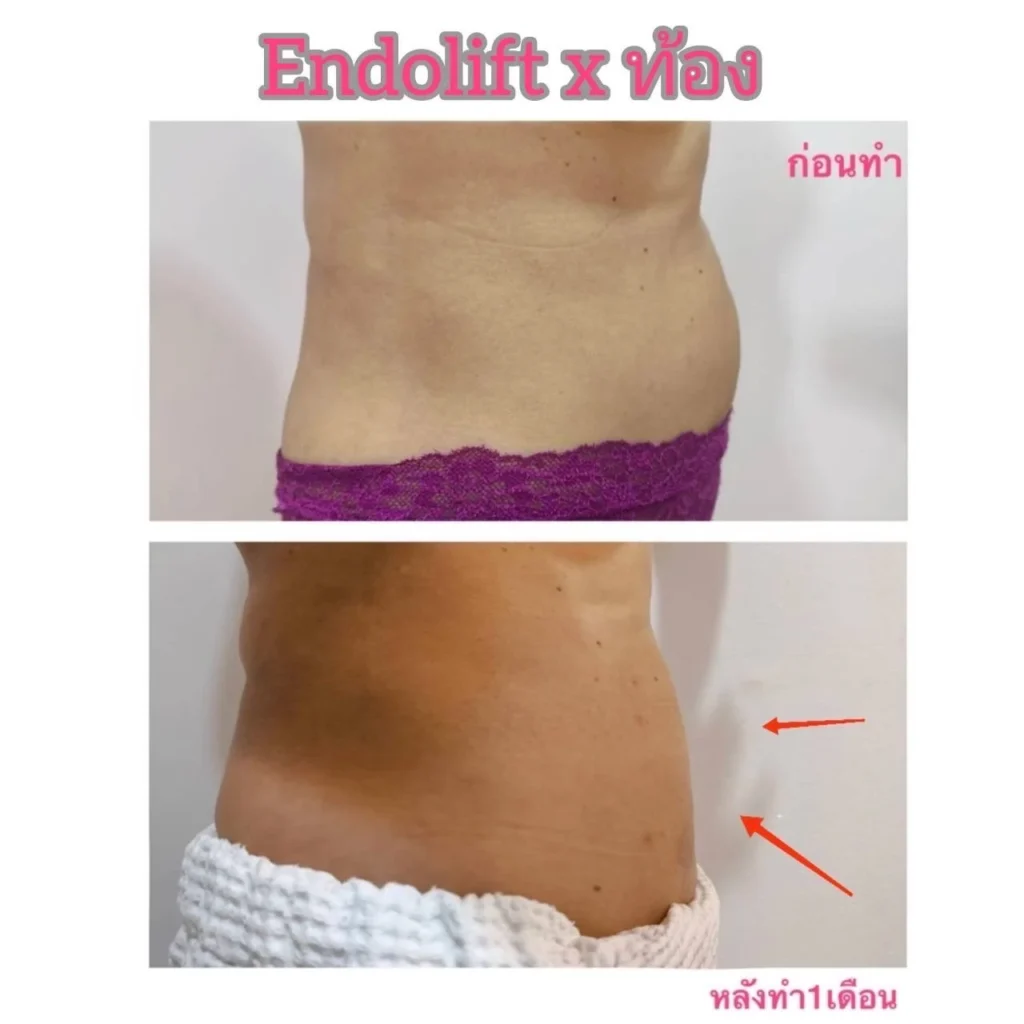 รีวิว EndoliftX 17