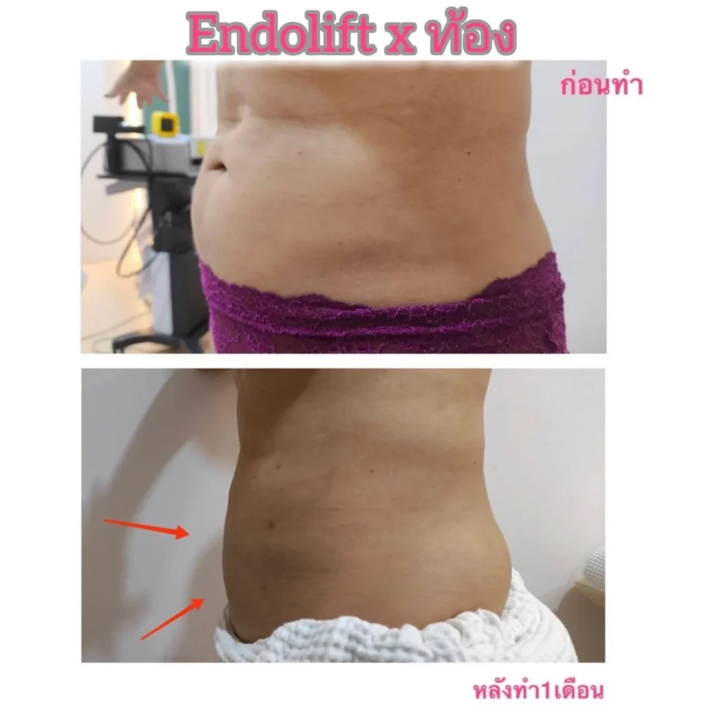 รีวิว EndoliftX 18