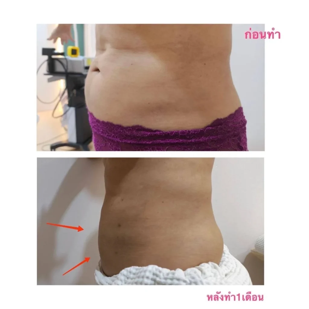 รีวิว EndoliftX 19