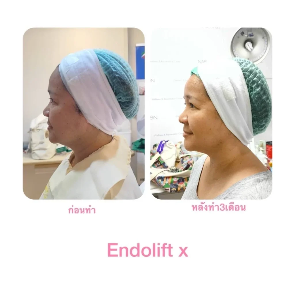 รีวิว EndoliftX 4