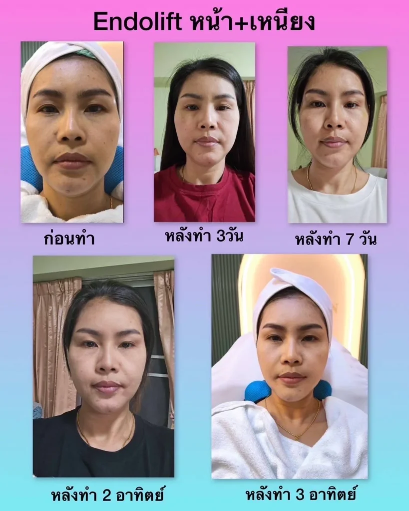 รีวิว EndoliftX 5