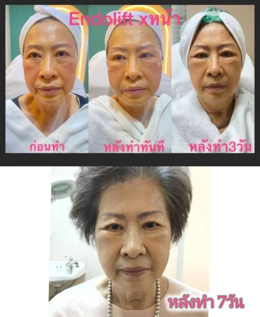 รีวิว EndoliftX 7