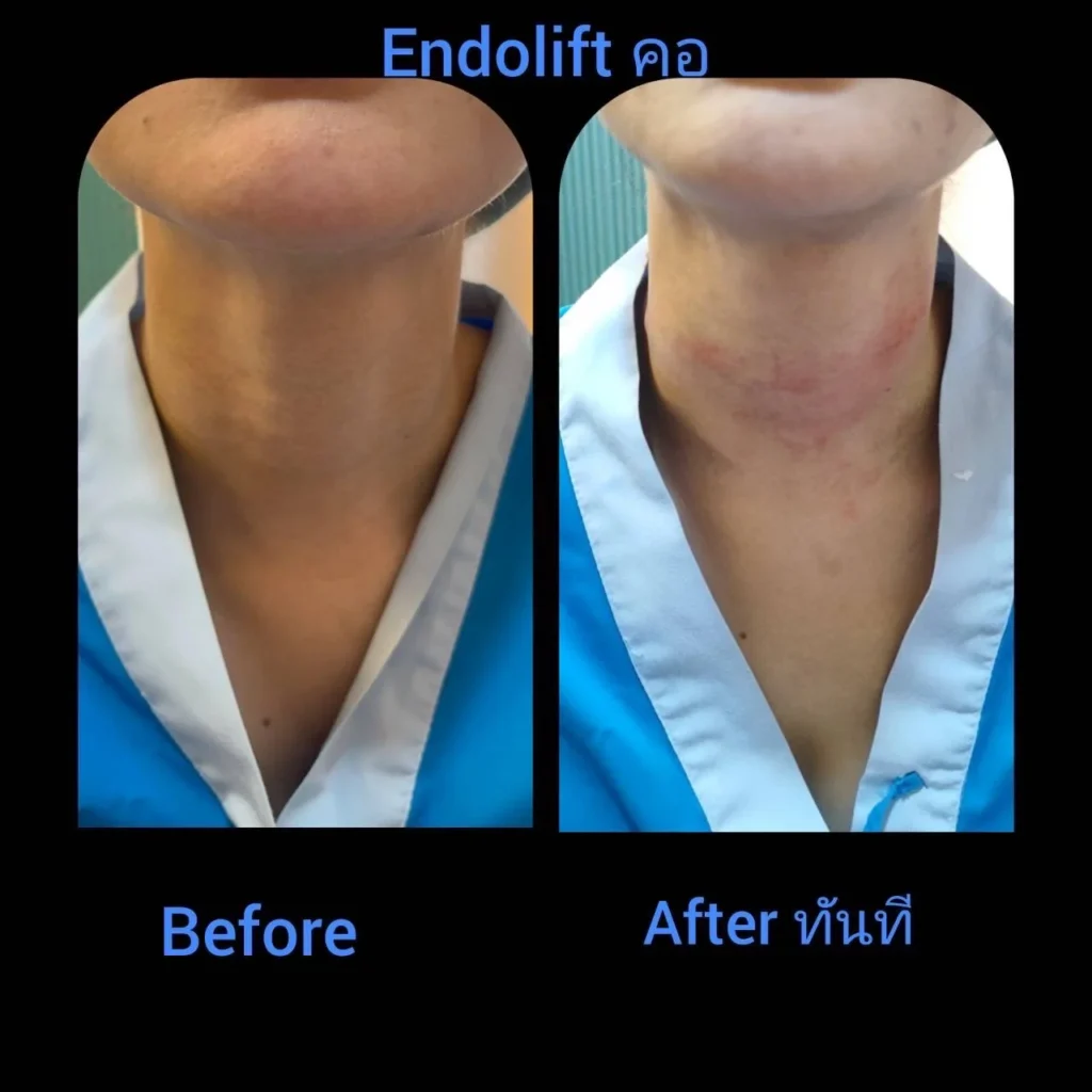 รีวิว EndoliftX 8