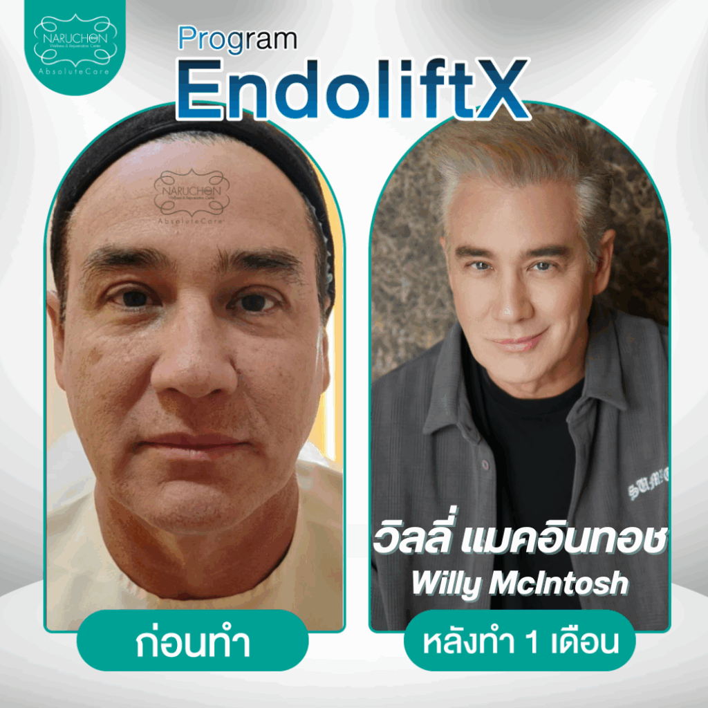 รีวิวendoliftX