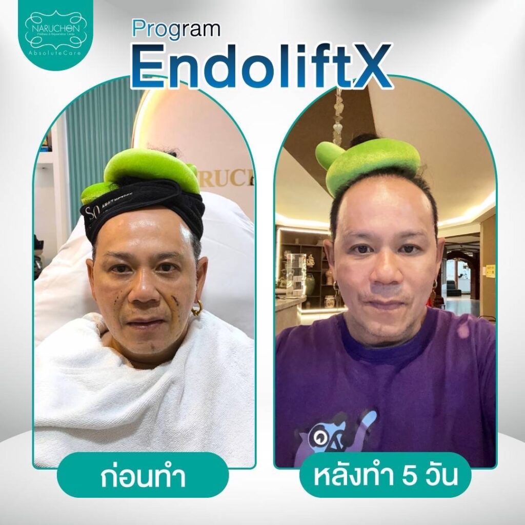 endolitX