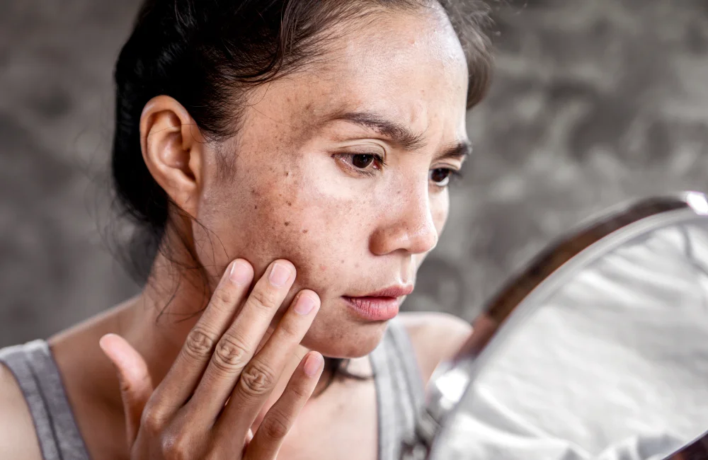 “ฝ้า” (Melasma) คืออะไร