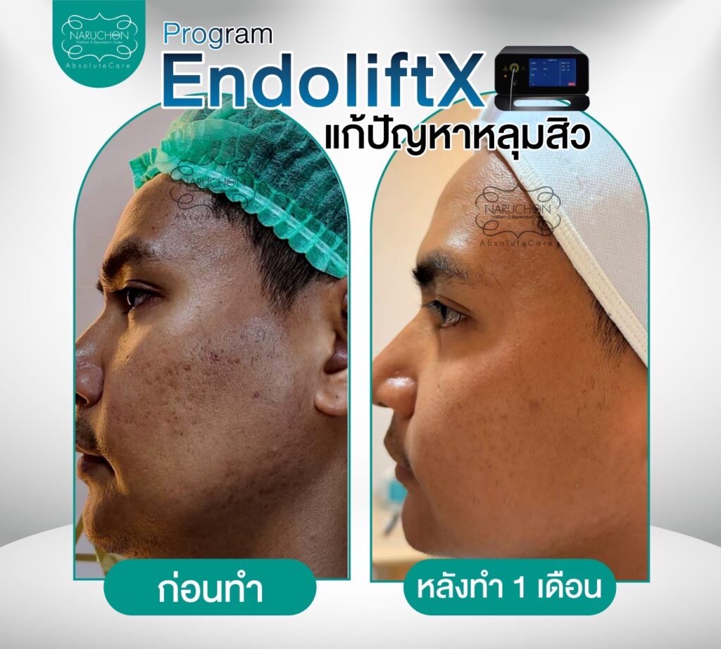 รีวิวการรักษาหลุมสิวที่ Naruchon Clinic