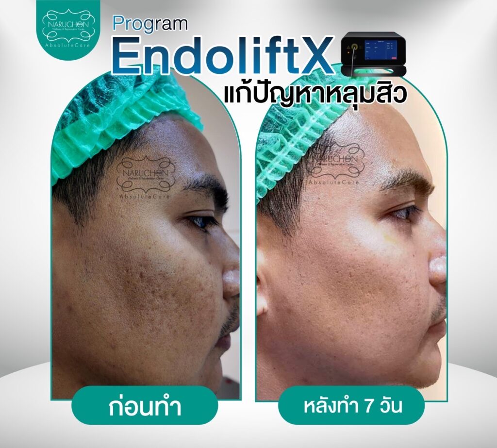 รีวิวการรักษาหลุมสิวที่ Naruchon Clinic