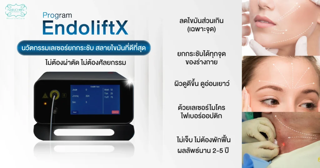 เทคโนโลยี Endolift x